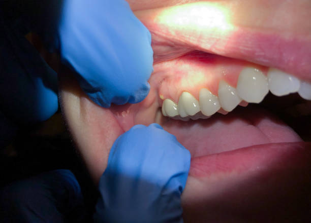 Best Chipped Tooth Repair Near Me  in Selah, WA